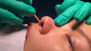 Nâng mũi bằng sụn có độ an toàn rất cao