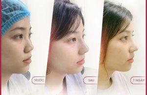 Nâng mũi bằng sụn tai sẽ giúp đem lại dáng mũi đẹp tự nhiên, thon gọn sau thời gian ngắn