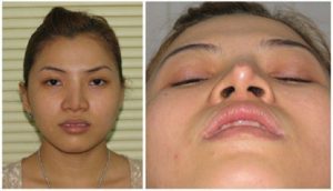 Nâng mũi bị tụt sụn gây biến dạng mũi mất thẩm mỹ