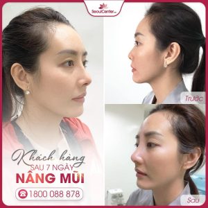Khách hàng sở hữu chiếc mũi cân đối và tự nhiên chỉ sau 7 ngày