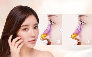 Kỹ thuật nâng mũi bằng sụn nhân tạo hiện nay đơn giản, an toàn