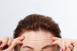 Tiêm filler trán là phương pháp giúp cải thiện khuyết điểm vùng trán