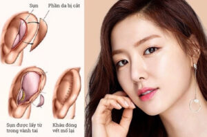 Thời gian lành của sụn tai sau phẫu thuật thường từ 3 - 4 tuần