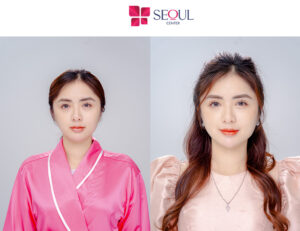 Thời gian duy trì kết quả cắt mí mắt trong khoảng 10 năm