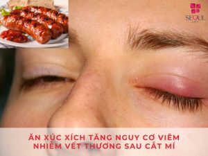 Việc ăn xúc xích sau cắt mí làm tăng nguy cơ viêm nhiễm vết thương