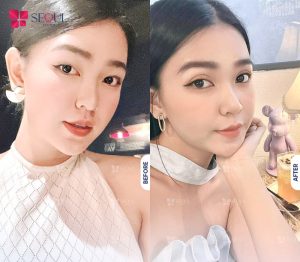 Người có khuyết điểm về mắt muốn khắc phục để lấy lại vẻ đẹp tự nhiên