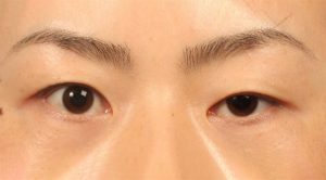 Nhược cơ mí mắt xuất hiện do tình trạng bị nhược cơ và các bệnh lý khác