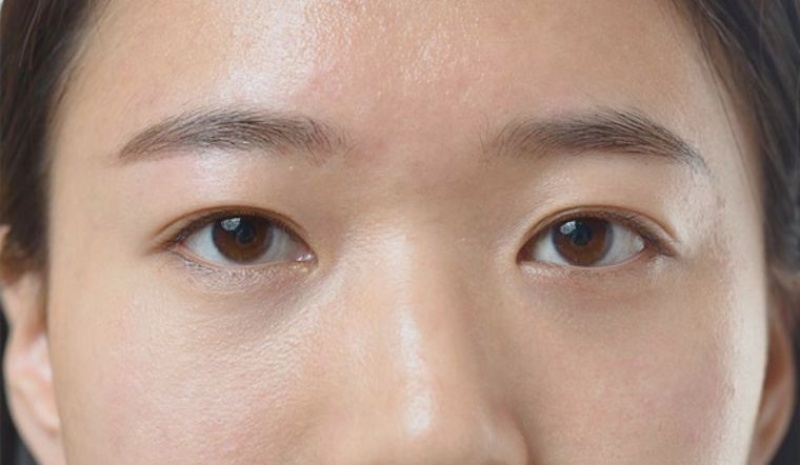 Mắt mí lót không thể hiện rõ nếp gấp mí thứ 2