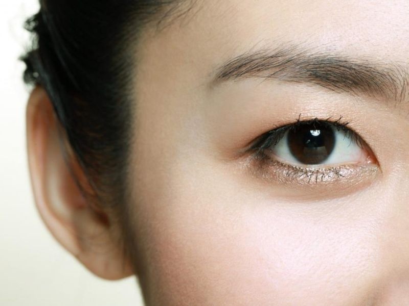 Mắt một mí không có nếp gấp mí trên
