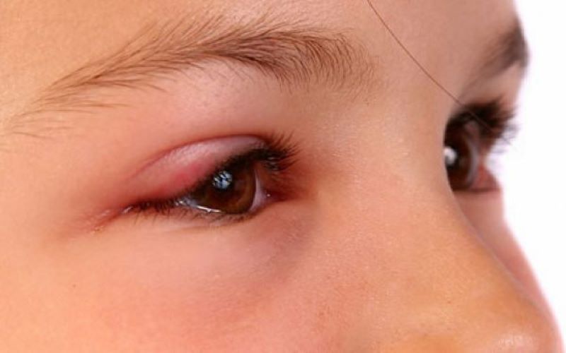 Cắt chỉ mí mắt bị sót không ảnh hưởng nghiêm trọng đến sức khỏe