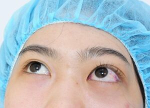 Bị mắt lồi có nên cắt mí không sẽ được chuyên gia giải đáp