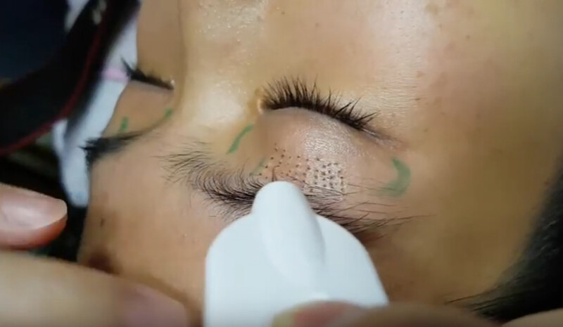 Nhấn mí mắt plasma là phương pháp gì?
