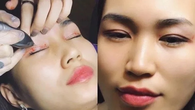 Nhấn mí mắt Plasma là công nghệ tạo hình mí mắt với đầu mũi kim cực nhỏ