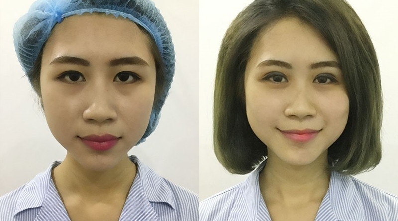 Nhấn mí với phương pháp plasma ít xâm lấn nên không gây cảm giác đau