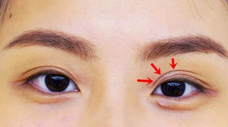 Bạn muốn có một quá trình nhấn mí nhẹ nhàng, an toàn thì Plasma rất phù hợp