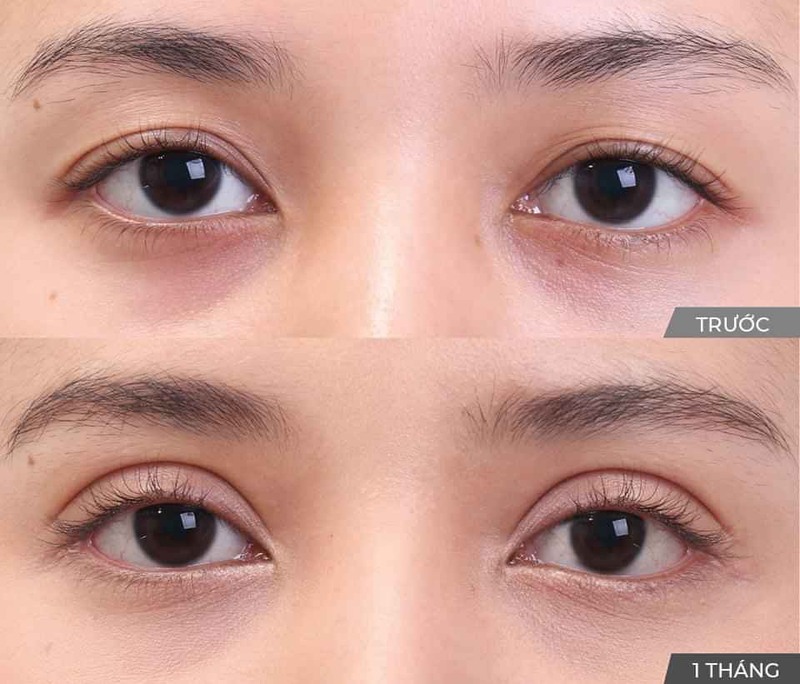 Nhấn mí plasma giữ được từ 3-5 năm với những người có cơ địa tốt