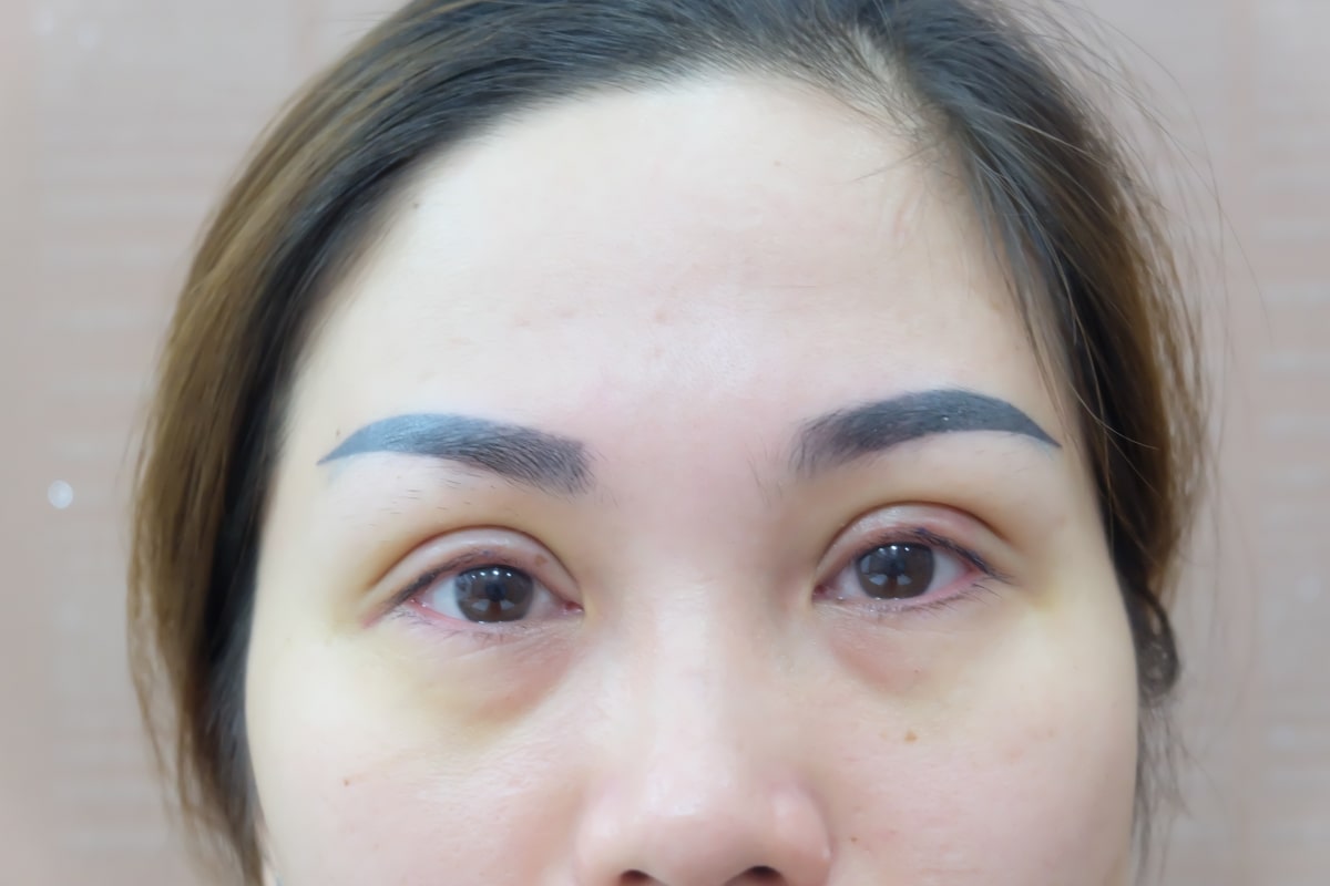 Cắt mí Full 5D – Phương pháp giữ nếp mí vĩnh viễn