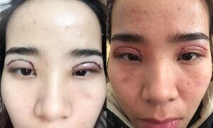 Có nhiều những nguyên nhân khác nhau gây nên tình trạng mắt không nhắm được