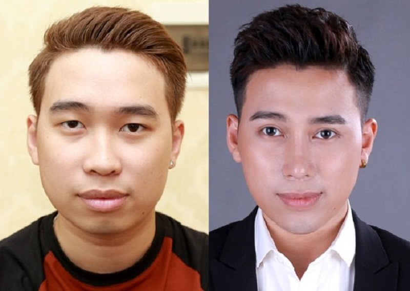 Cắt mí mắt nam là phương pháp cải thiện thẩm mỹ chiếm xu thế hiện nay
