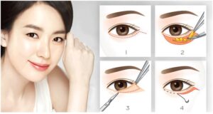 Lấy mỡ mí mắt thực hiện với thao tác nhanh chóng và đơn giản