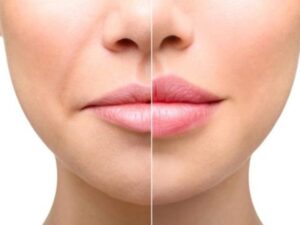 Đối tượng tiêm rãnh cười là những người đủ từ 22 tuổi mong muốn làm mờ rãnh cười, nếp nhăn