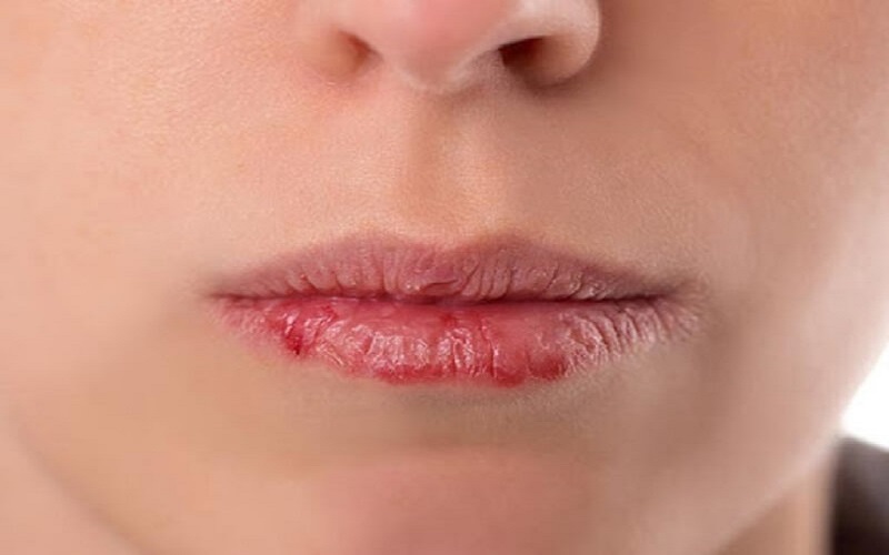 Dấu hiệu nhận biết phun môi bị cháy tê