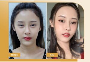 Tiêm filler má baby sẽ không gây ra bất kỳ ảnh hưởng xấu nào tới cơ thể của bạn