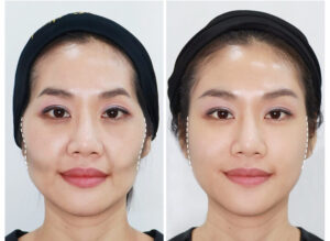 Tiêm filler má bao lâu thì mềm là khoảng 1 tháng sau khi tiêm