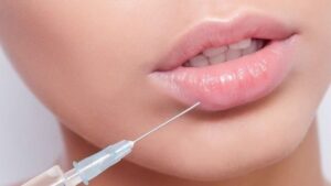 Tiêm filler môi an toàn mang lại đôi môi đẹp nhanh chóng