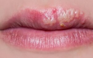 Xăm môi bị rộp là biểu hiện thường thấy