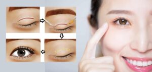 Cắt mắt 2 mí Hàn Quốc được xem là tiểu phẫu đơn giản