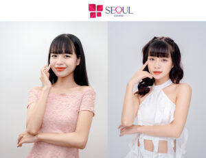 Hình ảnh khách hàng sau khi thực hiện phẫu thuật cắt mí sâu tây