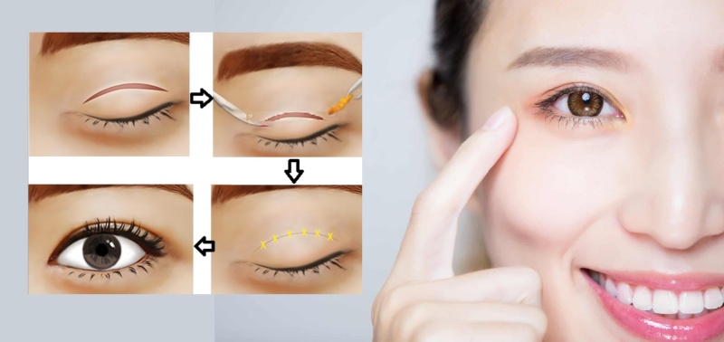   Cắt mí mắt là giải pháp khắc phục hiệu quả