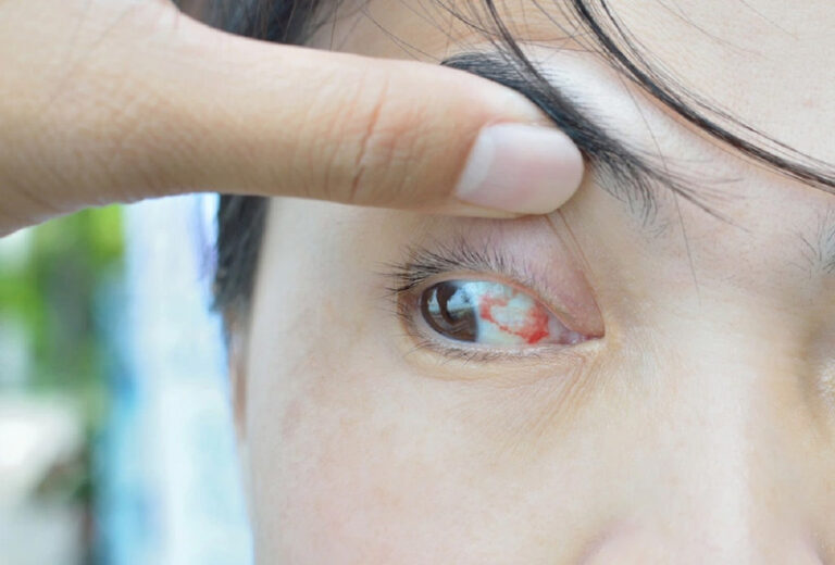 Vùng mắt có cảm giác ngứa, có mảng màu hồng trong mắt là dấu hiệu của mộng mắt