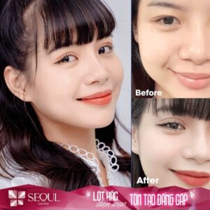 Seoul Center là địa chỉ phẫu thuật mắt đẹp đa tình chuyên nghiệp