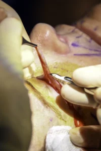Excess eyelid skin removal surgery
