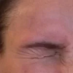 eyebrow lift ptosis eyelid droopy sagging