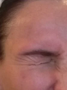 eyebrow lift ptosis eyelid droopy sagging