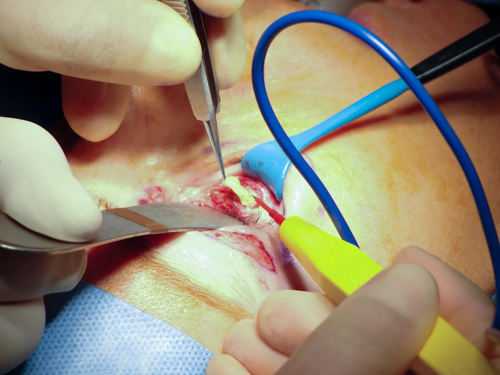 Thực phẩm nên và không nên ăn để mau lành sau nhấn mí?