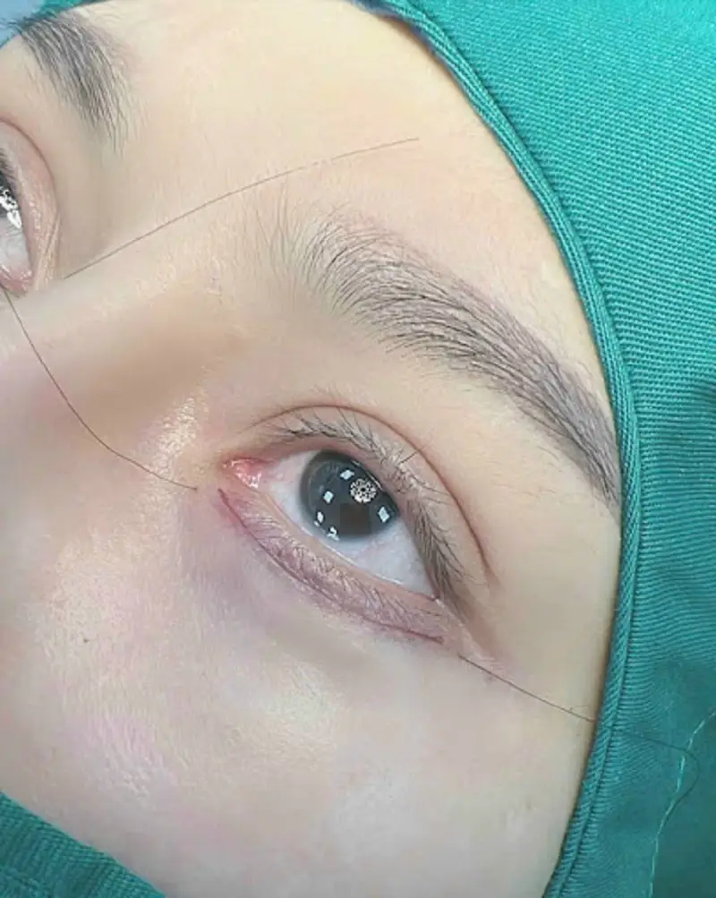 Cắt mí lộ đường mổ