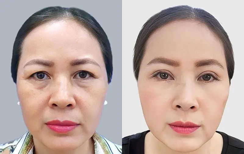 Lấy mỡ bọng mắt bị sưng