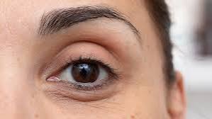lấy mỡ bọng mắt mắt có thể bị hõm