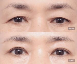 Cắt mí mắt nhiều da chùng