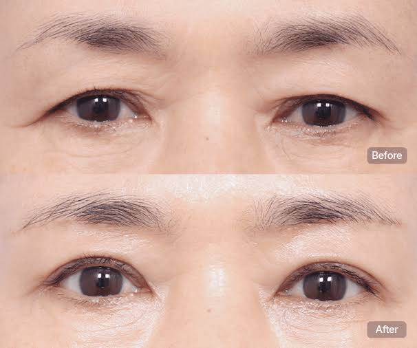 Cắt mí mắt nhiều da chùng