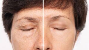 Nâng cung chân mày khắc phục sụp mí mắt
