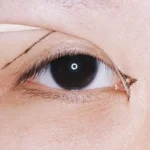 Mở góc mắt có để lại sẹo không?