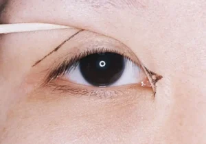 Mở góc mắt có để lại sẹo không?