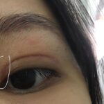 Cắt mí lộ đường mổ