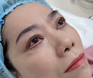 Mắt bị sưng sau khi lấy mỡ bọng mắt