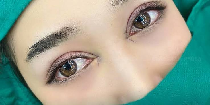 Mở góc mắt bao lâu thì lành